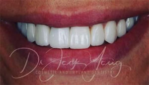 considering how much do veneers cost castle hill nsw