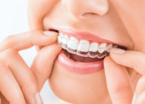 consider how much does invisalign cost castle hill