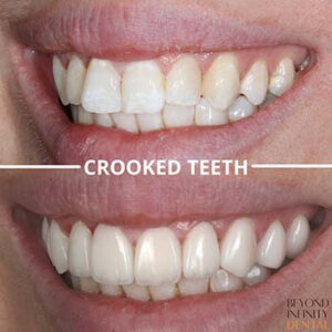 process veneers for crooked teeth castle hill