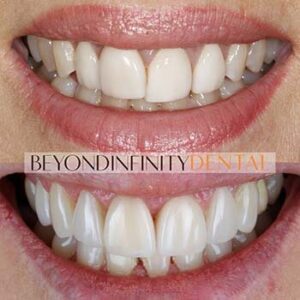 options how much does it cost to get porcelain veneers castle hill