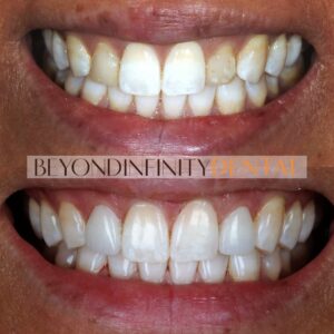 veneers how to fill a gap in your teeth castle hill