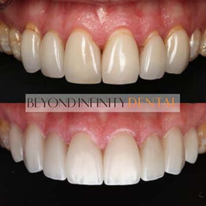 cosmetic dentistry how are veneers applied castle hill
