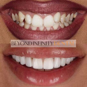 treatment how are veneers applied castle hill