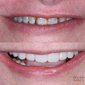 results tooth veneers castle hill