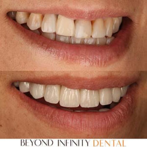 veneers results treatment castle hill