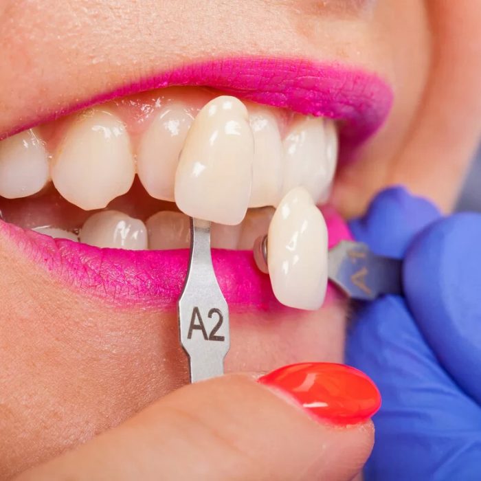 Can Porcelain Veneers be Reshaped Castle Hill