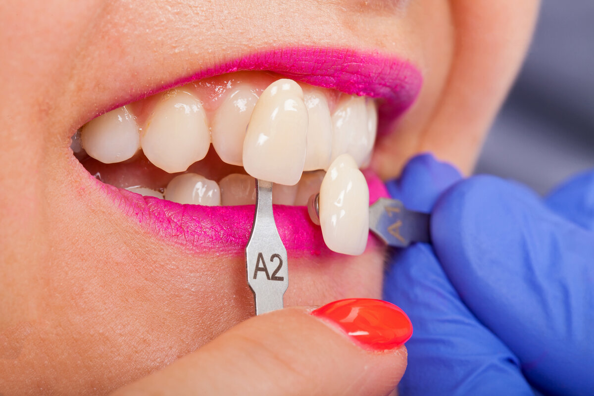 Can Porcelain Veneers be Reshaped Castle Hill