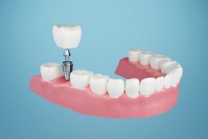 Dental Implants thailand cost