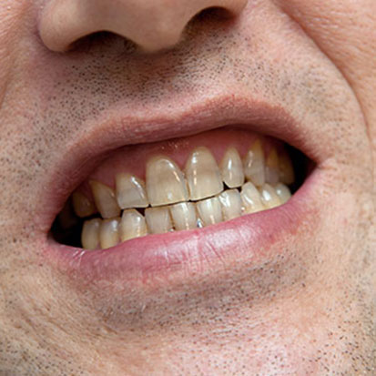 Stained-Discoloured-Teeth-Dental-Treatment-Castle-Hill-Beyond-Infinity-Dental-Treatment-Castle-Hill