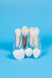 dental implant cost thailand missing tooth