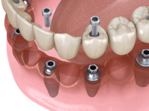 dental implant surgery castlehill