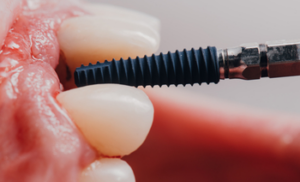dental implant treatment castlehill