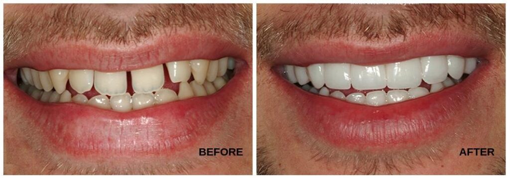 dental-veneers-before-and-after-results