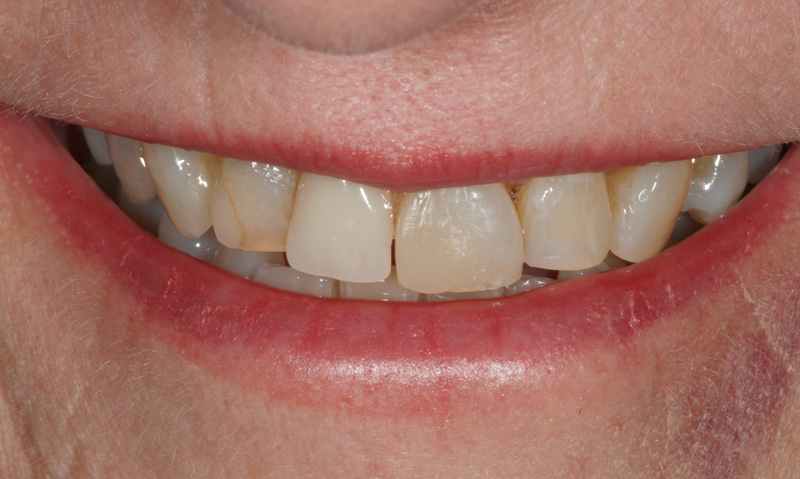 Dental-Crowns-Bridges-before