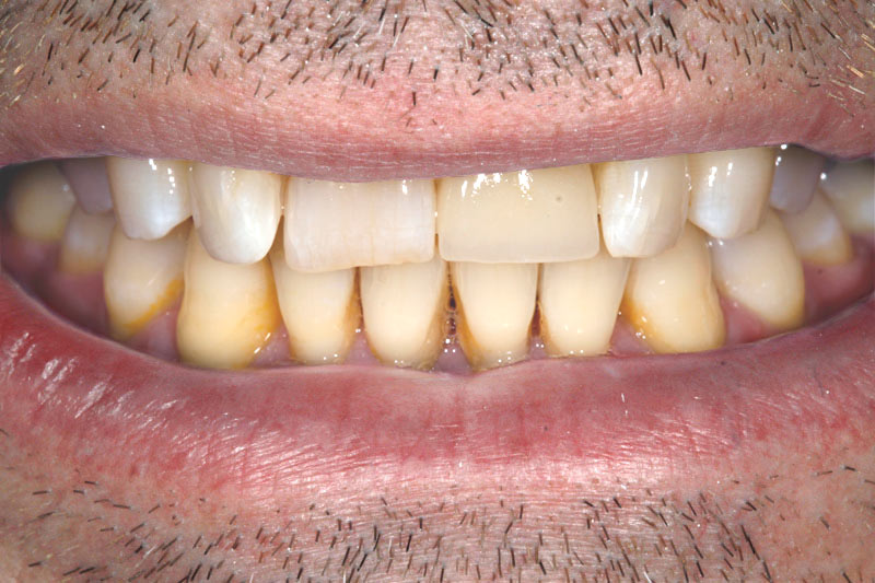 Dental-Implant-after