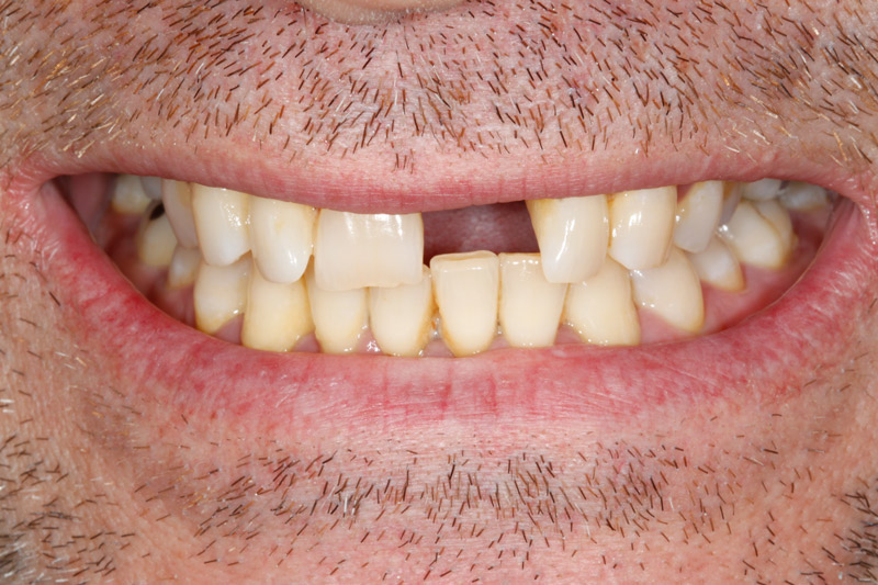 Dental-Implant-before