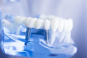 How Much for Dental Implants bridge implant