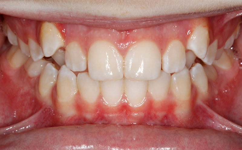 Jutting-teeth-re-adjusted-before