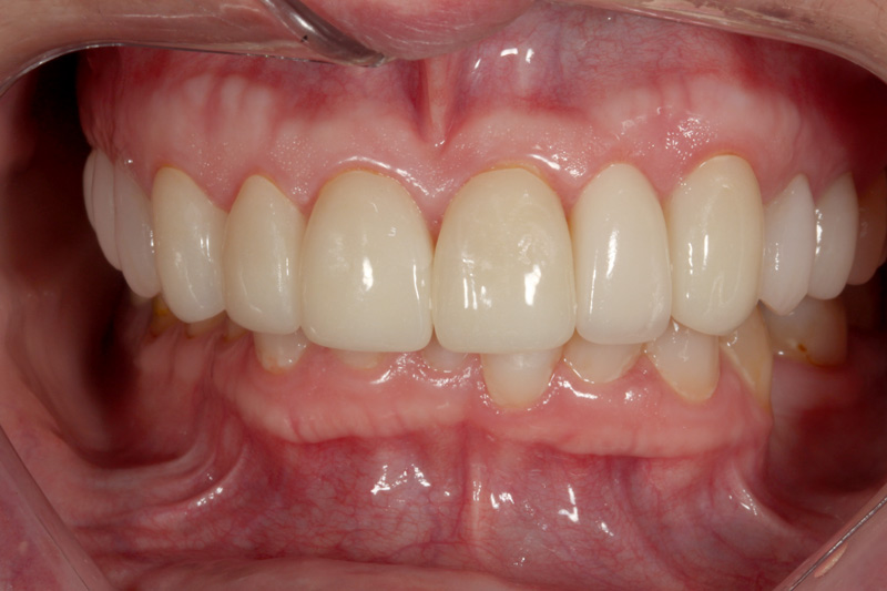 TMJ-resolved-with-Crowns-Bridges-closeup-after