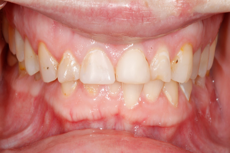 TMJ-resolved-with-Crowns-Bridges-closeup-before