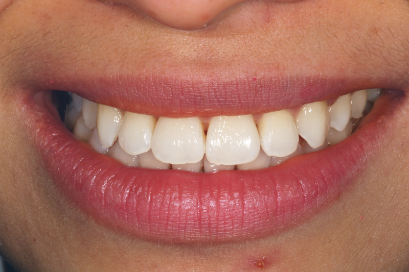 Underbite-adjusted-with-Adult-Braces-After