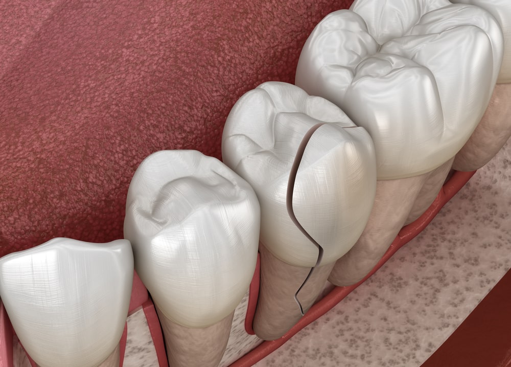 Cracked Chipped Teeth Treatment