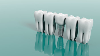 Cost Of Dental Implants In Australia image