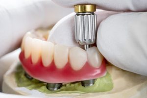 all on 4 dental implants procedure