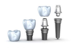 all-on-4-dental-implants-castle-hill