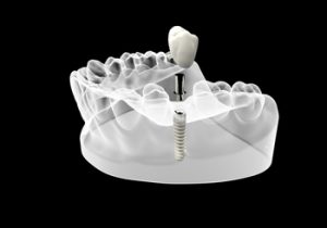 single-tooth-implant-cost-australia-illustration-castle-hill