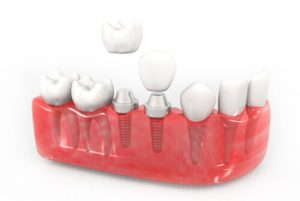single tooth implant cost australia number of teeth castle hill