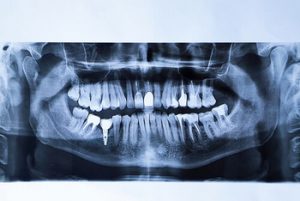 single tooth implant cost australia x-ray castle hill
