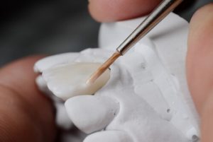 veneers cost philippines application castle hill