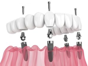 Full Mouth Dental Implants Cost Australia illustration castle hill