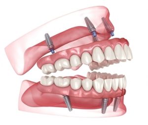 Cost-For-Full-Mouth-Dental-Implants-image-castle-hill