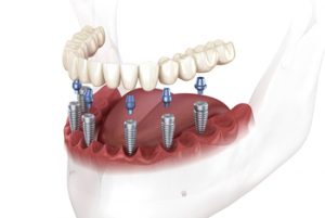 Cost-for-Full-Mouth-Dental-Implants-posts-castle-hill