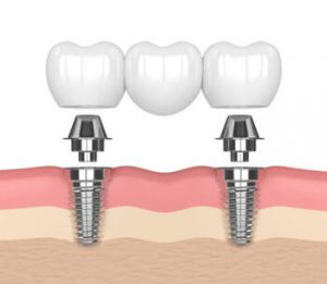 Dental Implants Vs Bridge comparison castle hill
