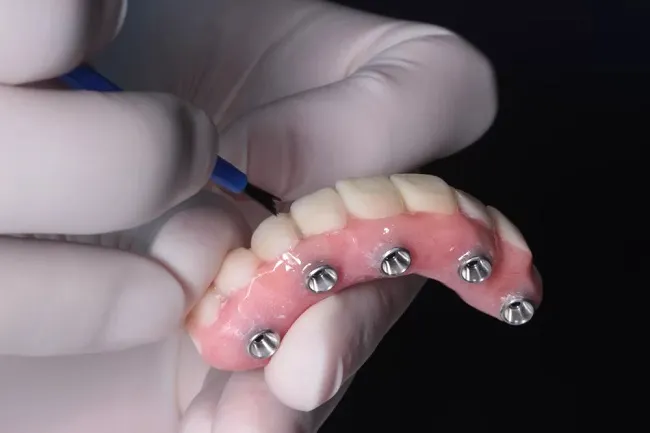 THE FULL ARCH DENTAL IMPLANT PROCEDURE