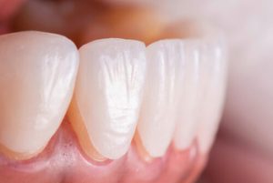 can you whiten veneers application castle hill