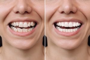 difference of veneers castle hill