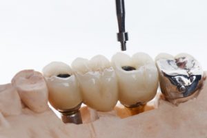 low cost teeth implant castle hill 