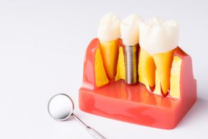 low price tooth implant castle hill