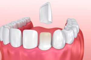 differentiating invisalign and veneers castle hill