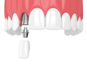 Dental Implants Philippines illustration castle hill