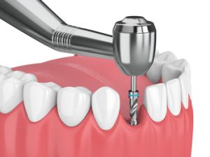 costs of dental implants overseas castle hill