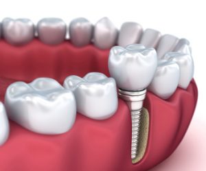 dental-implants-turkey-illustration-caste-hill
