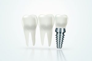 fees of dental implants india castle hill