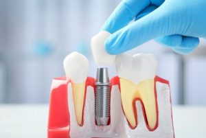 Full Mouth Dental Implants Cost Thailand single implant