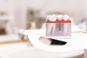 Dental Insurance That Covers dental Implants