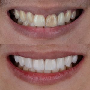 can you eat with veneers veneers benefit